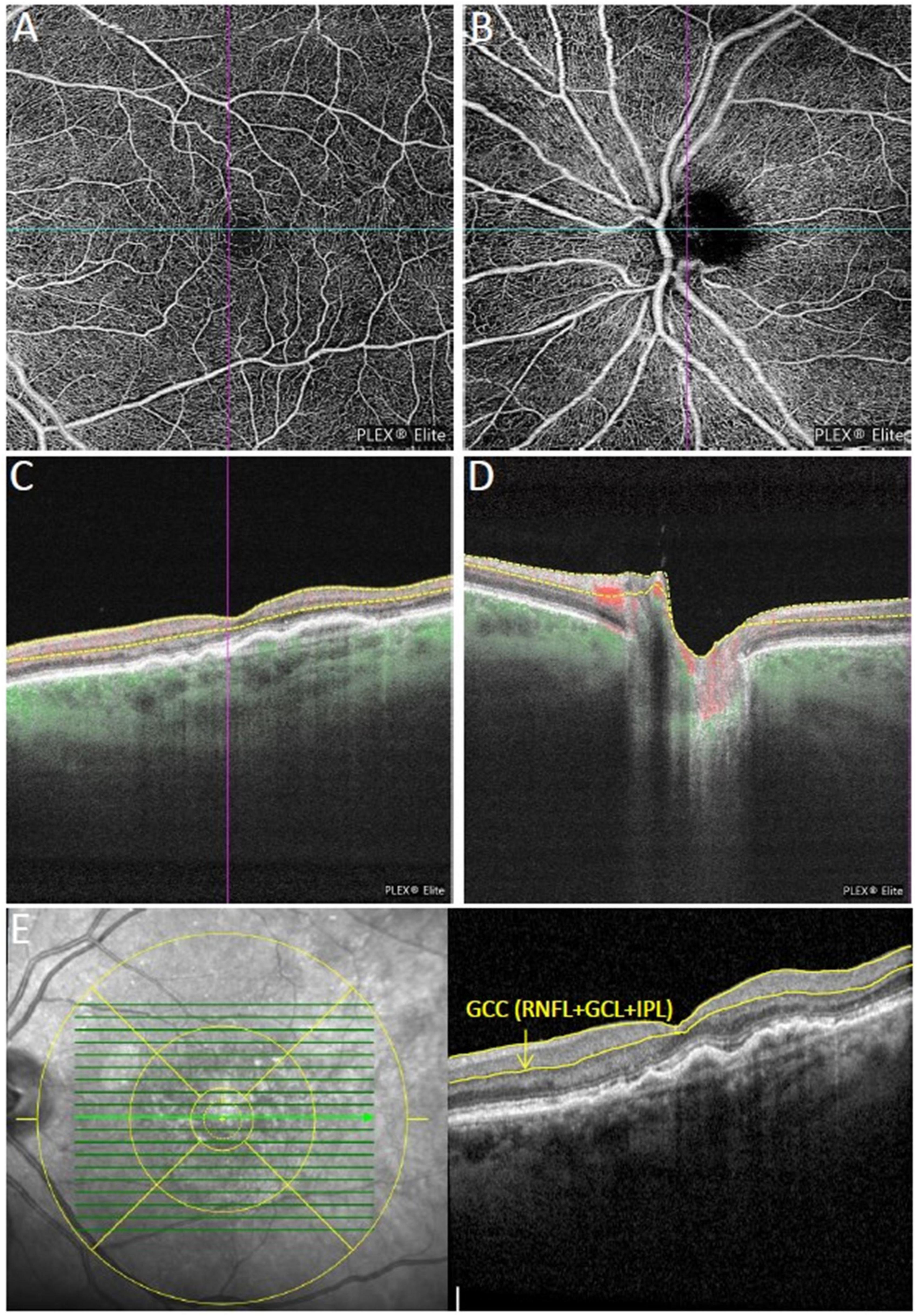 Peripapillary and macular microvasculature in neovascular age-related macular degeneration in long-term and recently started anti-VEGF therapy versus healthy controls